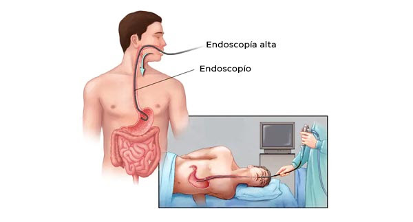 Endoscopia Alta